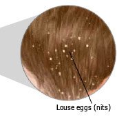 Loue eggs (nits)